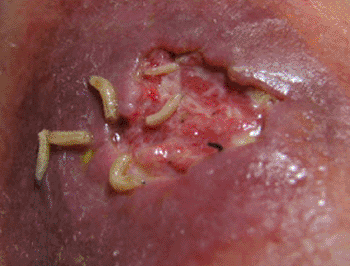Image: Lucilia sericata maggots cleaning wound surfaces (Photo courtesy of Centre Hospitalier Universitaire Caen).